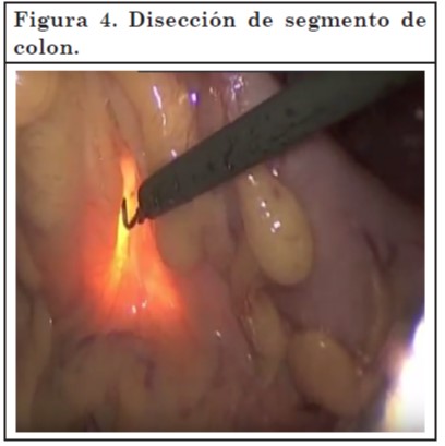 Vaginoplastia 04