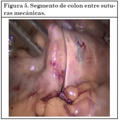 Vaginoplastia 05