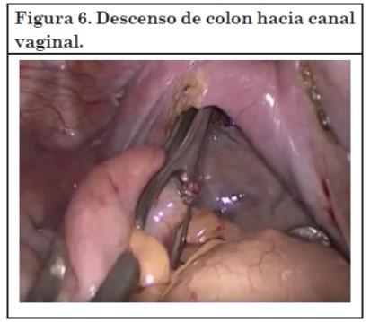 Vaginoplastia 06