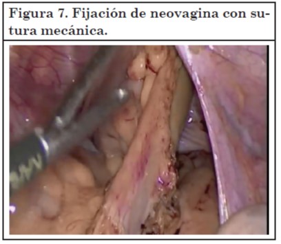 Vaginoplastia 07